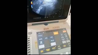 Esaote Mylab Gamma TVS pregnancy ultrasound medicalequipment [upl. by Hallee]