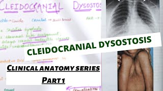 CLINICAL ANATOMY Part 1  Cleidocranial Dysostosis  Suyash shukla [upl. by Healion]