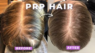 HAIR PRP Therapy  BEFORE AND AFTER Jillian Lansky [upl. by Aititil]