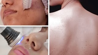 How To Get Rid Of Body Acne Scars And Pimple Marks Forever [upl. by Torras]