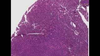 Histopathology LungSmall cell carcinoma [upl. by Senga]