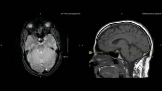 Unremarkable Non Contrast Brain MRI Axial Gradient Echo  Example 1 [upl. by Ibbob]