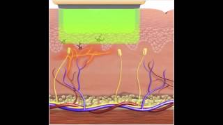 How IPL  Photorejuvenation works for Vascular Lesions [upl. by Relluf]