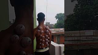 how to do cupping therapy at home 🏡hijama physiotherapy srms workout gym tranformation sports [upl. by Ahseele173]