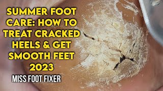 Summer Foot Care How to Treat Cracked Heels and Get Smooth Feet by foot Specialist Miss foot Fixer [upl. by Gennifer821]