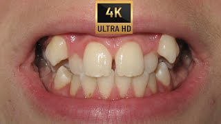 🤔HOW BRACES WORK for Severe Crowding❓ An Orthodontic Treatment in 14 years old in 4K💕 [upl. by Negem]