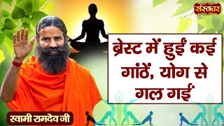 ब्रेस्ट में हुईं कई गाठें योग से गल गईं  Lumps Treatment  Yoga and Ayurveda  Swami Ramdev Ji [upl. by Eitsirhc365]