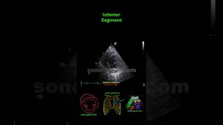 Echocardiography  Inferolateral And Inferior Hypokinesia [upl. by Ititrefen]