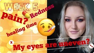 Strabismus surgery squintlazy eye update  Recovery week 5 [upl. by Veleda]