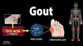 Gout Pathophysiology Causes Symptoms Risk Factors Diagnosis and Treatments Animation [upl. by Hanny97]