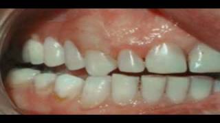 Why Have a Valplast Flexible Denture [upl. by Lebyram]