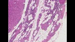 Histopathology ParathyroidOxyphil adenoma [upl. by Meirrak]