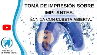 📋GUÍA PASO A PASO Impresión de implantes con cubeta abierta [upl. by Stetson]