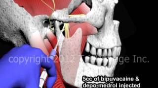 Bupivacaine Anesthesia of the Temperomandibular Joint TMJ  Animation by Cal Shipley MD [upl. by Eceined]