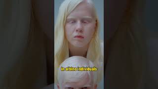 What Is Albinism [upl. by Forelli]