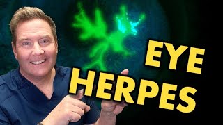 Eye COLD SORE diagnosis amp treatment of eye herpes [upl. by Daphna]