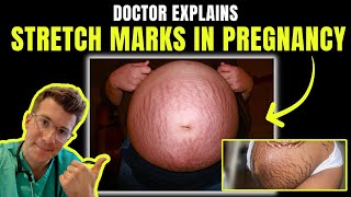 Doctor explains STRETCH MARKS in PREGNANCY  including signs clinical photos causes treatment [upl. by Ynetruoc]