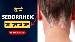 Seborrheic Dermatitis का इलाज  How To Treat Seborrheic Dermatitis कैसे seborrheic का इलाज करे [upl. by Whit]