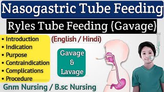 Nasogastric Tube Feeding Gavage  NG Tube Feeding  Ryles Tube Feeding [upl. by Adolph137]