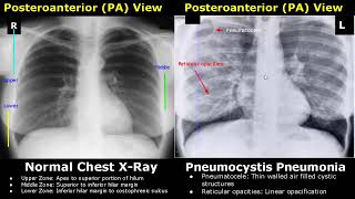 Chest XRay Lung Normal Vs Abnormal Image Appearances Part 1  TBPneumoniaConsolidationCollapse [upl. by Yrannav]