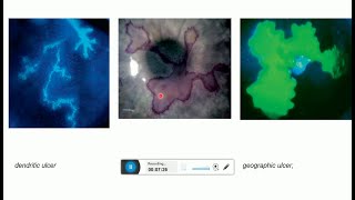 herpes simplex keratitis and herpes zoster ophthalmicus [upl. by Avirt]