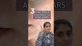 How to get rid of Acne Scars  Acne Scars Treatment  Acne Scars shorts [upl. by Pirri]