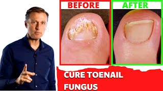 Treating toenail fungus Home Remedy Natural  Dr Berg [upl. by Sayers689]