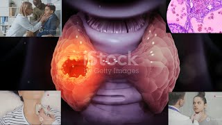 Tumor Markers  Calcitonin  Medullary Thyroid Cancer MTC  The quotbutterflyquot organ  08 [upl. by Nitsuga]