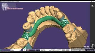 Upper Partial Denture designing [upl. by Tigirb]