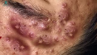 Big Cystic Acne Blackheads Extraction Blackheads amp Milia Whiteheads Removal Pimple Popping [upl. by Enier907]