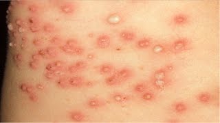 Home remedies for impetigo [upl. by Ariait21]