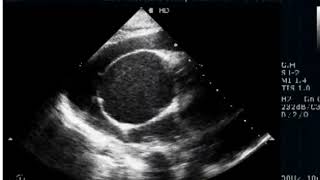 Severe Pulmonic Stenosis  RV non Compaction [upl. by Nalaf]