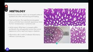 Hyperplastic Polyps Histology [upl. by Dombrowski]