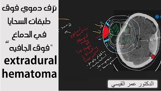 epidural or extradural hematoma  نزف دموي فوق طبقات السحايا في الدماغ quotفوق الجافيهquot [upl. by Heller]