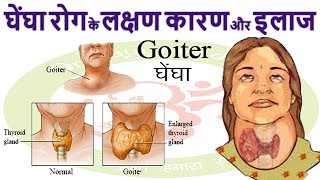 घेंघा  Goiter  रोग Enlarged Thyroid Gland के लक्षण कारण और इलाज [upl. by Hernandez502]