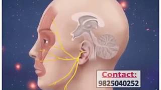 Trigeminal neuralgia treatment radio frequency ablation in ahmedabad gujrat [upl. by Thanh]