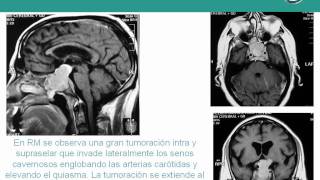 NeurorgsnetMacroadenoma de Hipófisis [upl. by Mraz]