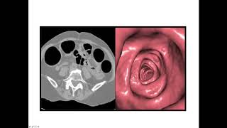 Virtual colonoscopy aka CT Colonography explained [upl. by Aicilegna]