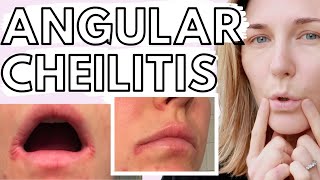 Lip Eczema amp Angular Cheilitis  10 TIPS for Dealing with Eczematous Angular Cheilitis [upl. by Navanod]