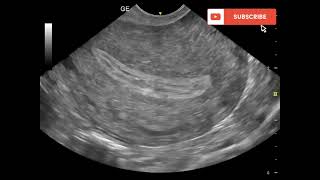 early pregnancy ultrasoundintradecidual sign [upl. by Rapsac]