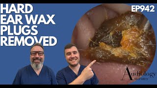 HARD EAR WAX PLUGS REMOVED  EP942 [upl. by Maxfield944]