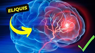 Eliquis The Revolutionary Anticoagulant for Stroke and Blood Clot Prevention [upl. by Sierra177]