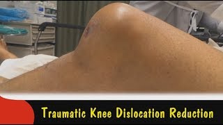 Traumatic Knee Dislocation Reduction [upl. by Alethea]