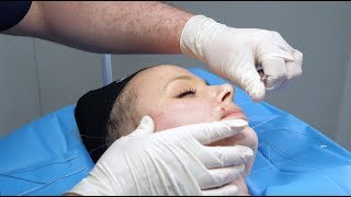 Silhouette Soft ThreadLift  Live Procedure at The Laser and Skin Clinic [upl. by Atselec]