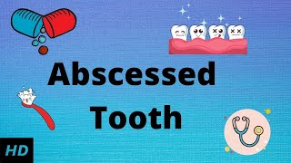 Abscessed tooth Causes SIgns and Symptoms Diagnosis and Treatment [upl. by Lani]