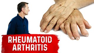 Use These Spices and Herbs for Rheumatoid Arthritis – Remedies for Rheumatoid Arthritis – DrBerg [upl. by Dnaltroc]