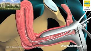 Endometrial Biopsy Hindi  CIMS Hospital [upl. by Senga]