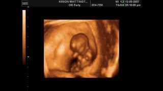 Amazing Dancing Baby in the Womb 11 Weeks [upl. by Germayne]