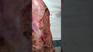 Venous stasis ulceration with pyoderma gangrenosum [upl. by Mahda]