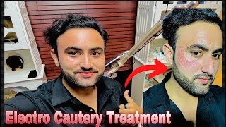 Electro Cautery Face Treatment  For Skin tags Removal facetreatment vlog viralvideo viralvlogs [upl. by Takakura]